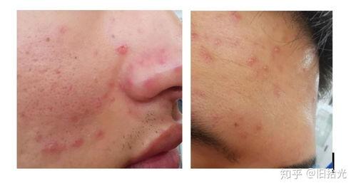 成人水痘自测视频下载,快速识别症状，守护健康  第2张