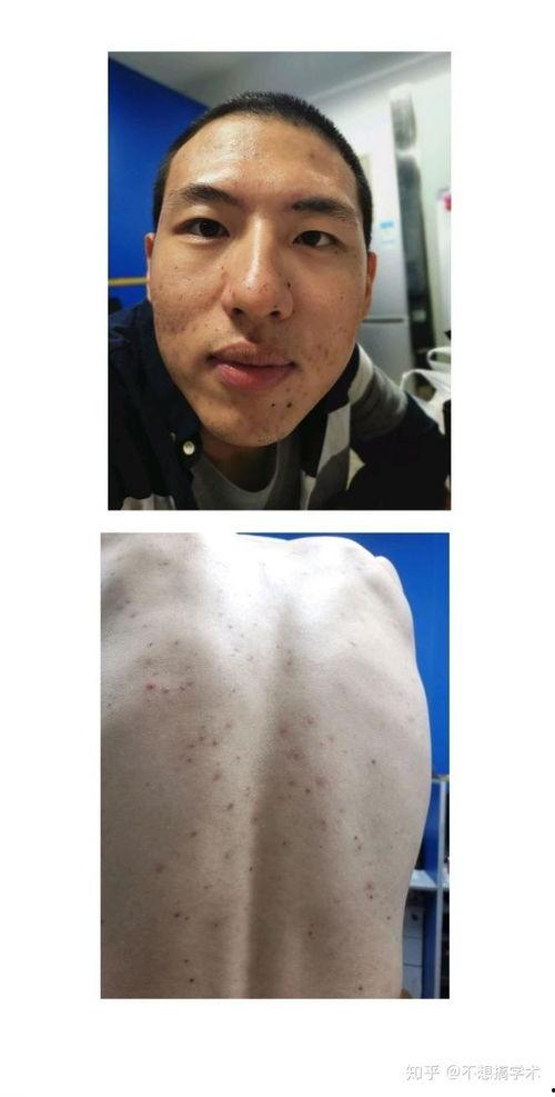 成人水痘自测视频下载,快速识别症状，守护健康  第3张